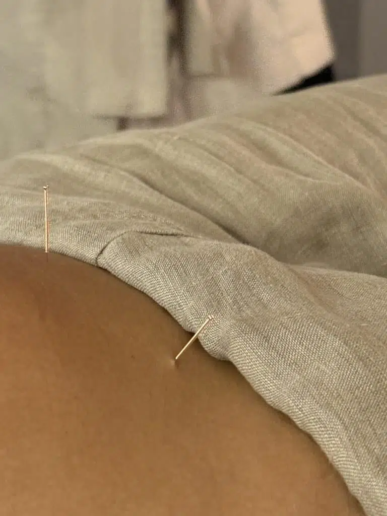 Sesión de acupuntura con enfoque en contracturas musculares y estrés