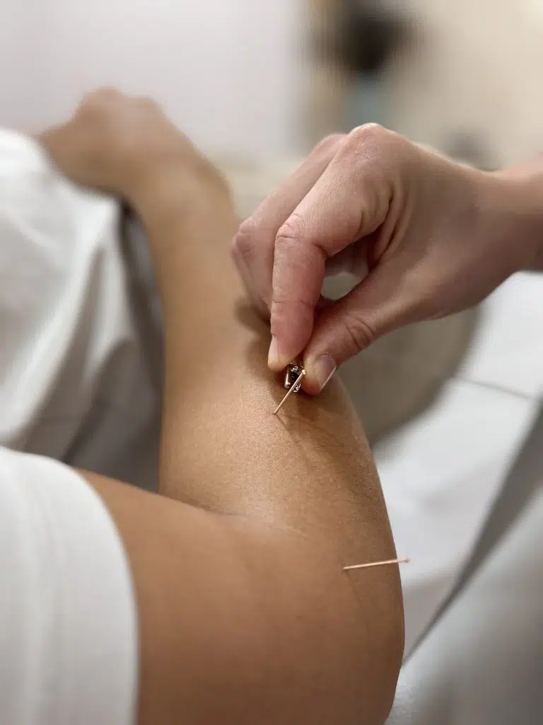 Estimulación eléctrica con agujas de acupuntura en el brazo de paciente