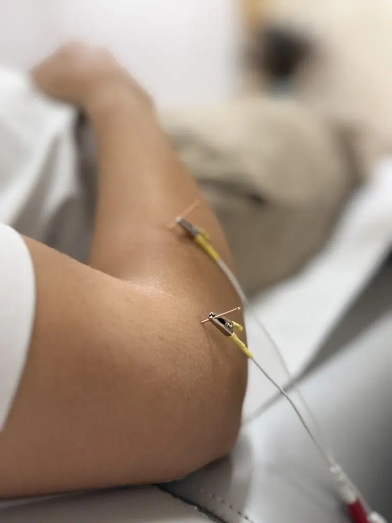 Estimulación eléctrica sobre agujas de acupuntura en el brazo de paciente