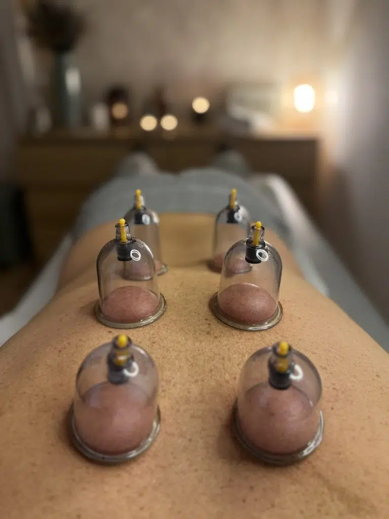 Ventosas de cupping colocadas sobre la piel en consulta profesional