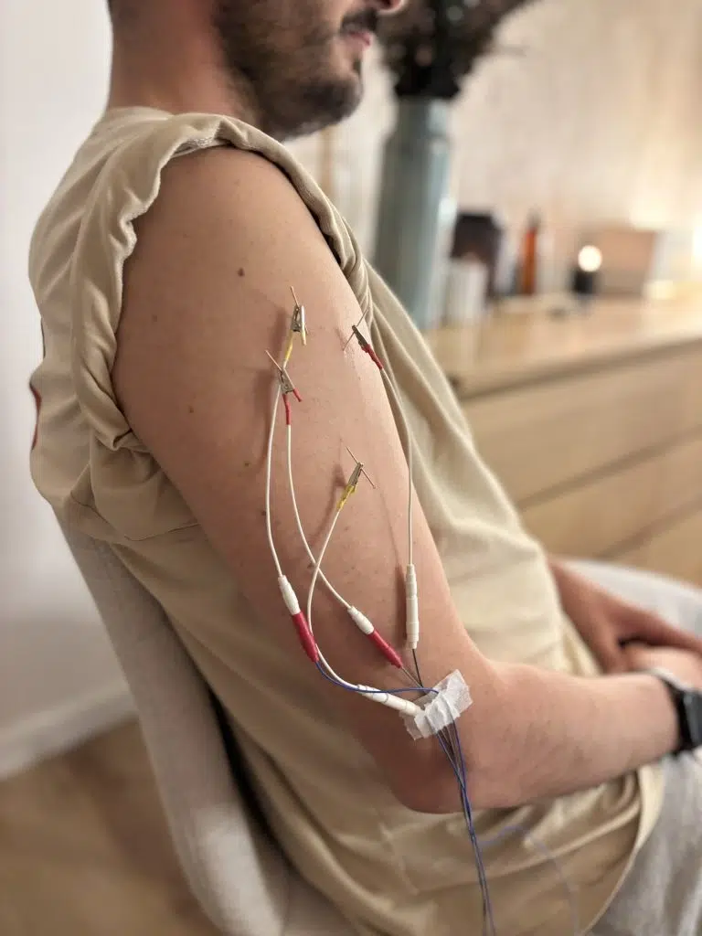 Técnica de electroacupuntura aplicada a hombro con varios electrodos