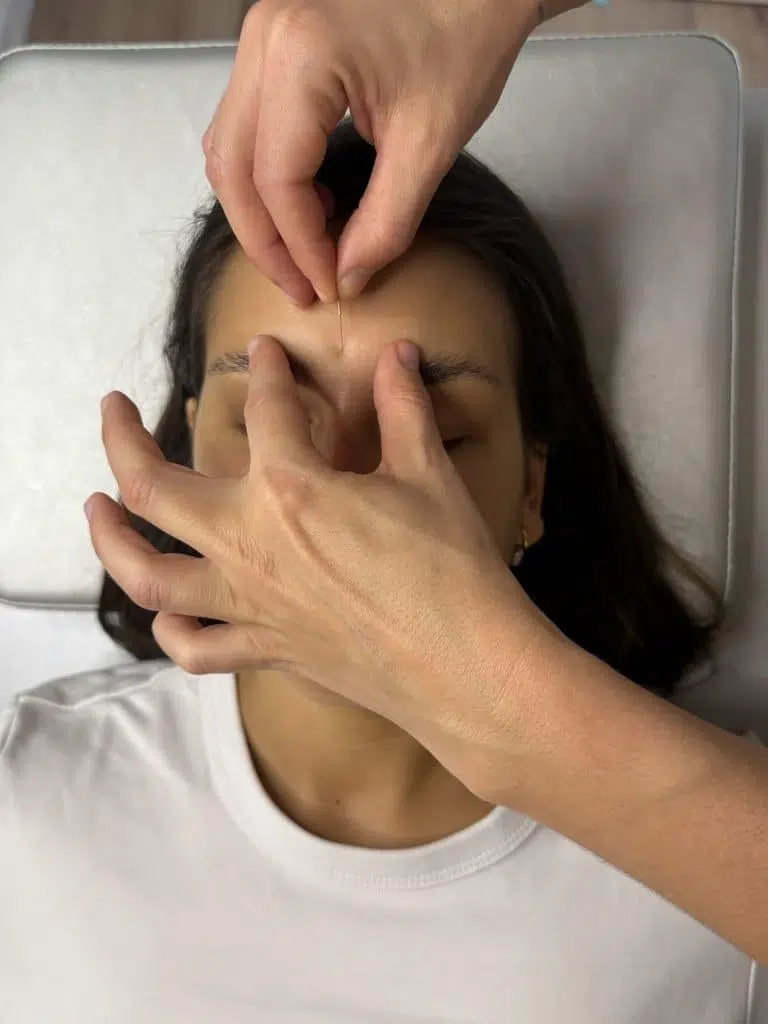Aplicación de aguja en el entrecejo durante sesión de acupuntura facial