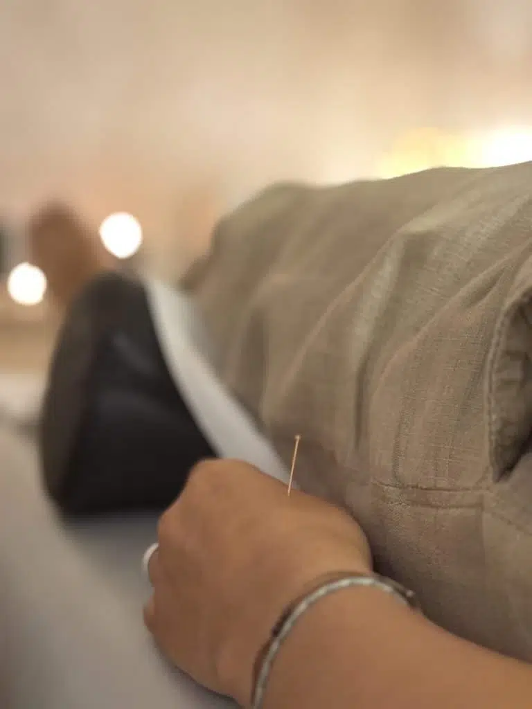 Agujas de acupuntura en la mano durante terapia personalizada