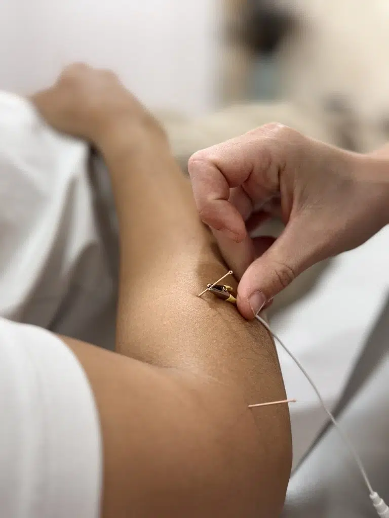 Estimulación eléctrica en acupuntura tradicional con enfoque terapéutico