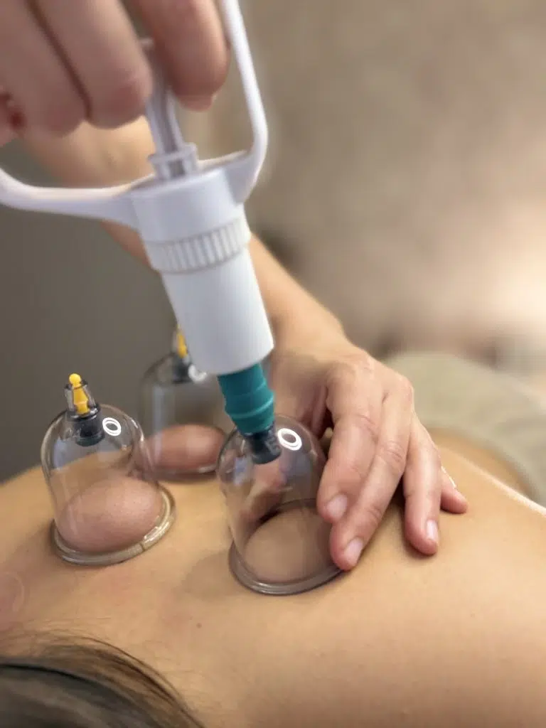 Cupping aplicado en zona superior de la espalda para tratar molestias