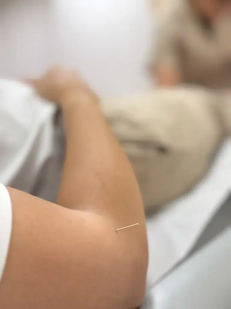 Aplicación de acupuntura en el codo en centro de acupuntura china en Barberá del Vallés