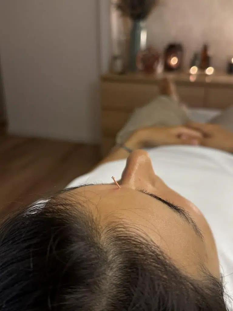 Aguja de acupuntura facial insertada en centro de acupuntura en Barberá del Vallés