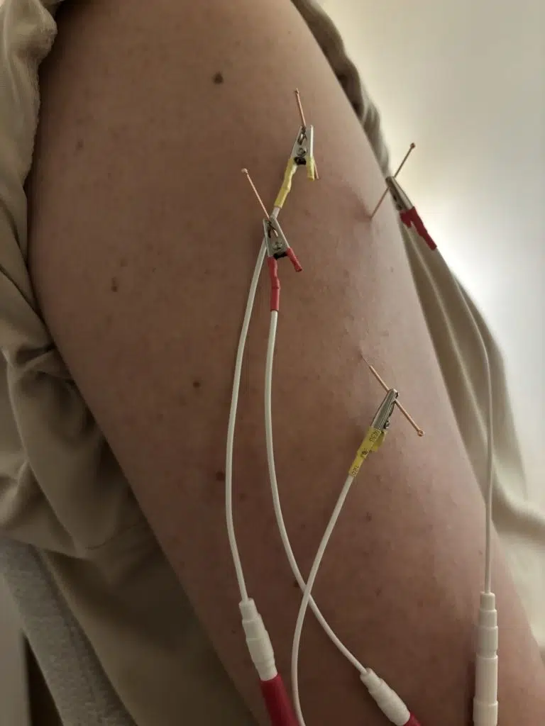 Electroacupuntura aplicada en centro especializado con cables y electrodos